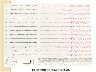 ELECTROENCEFALOGRAMA
 