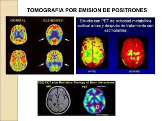 TOMOGRAFIA POR EMISION DE POSITRONES
 