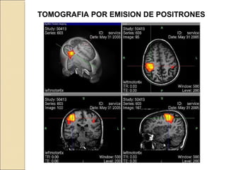 TOMOGRAFIA POR EMISION DE POSITRONES
 