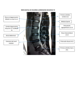 RMN SAGITAL DE COLUMNA LUMBOSACRA SECUENCIA T2
Primera vértebra lumbar (L1)
Médula Espinal
Articulación cigoapofisiaria L2-L3
Disco intervertebral L3-L4
Protrusión discal L4-L5
Estenosis del canal medular
Primera vértebra Sacra (S1)
Aorta Abdominal
Cambio degenerativo Discal en L2- L3 (Modic II)
Disco sin degeneración (Modic I) a nivel L1-L2