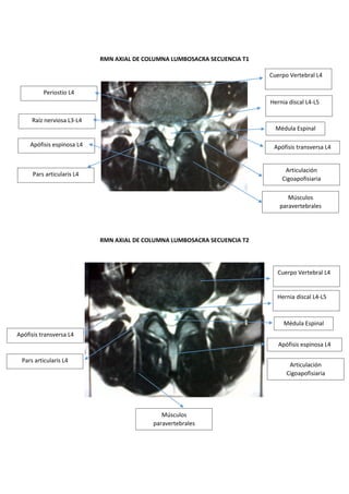 RMN AXIAL DE COLUMNA LUMBOSACRA SECUENCIA T1
RMN AXIAL DE COLUMNA LUMBOSACRA SECUENCIA T2
Cuerpo Vertebral L4
Hernia discal L4-L5
Médula Espinal
Apófisis transversa L4
Articulación Cigoapofisiaria
Pars articularis L4
Músculos paravertebrales
Apófisis espinosa L4
Raíz nerviosa L3-L4
Periostio L4
Cuerpo Vertebral L4
Hernia discal L4-L5
Médula Espinal
Apófisis espinosa L4
Articulación Cigoapofisiaria
Músculos paravertebrales
Pars articularis L4
Apófisis transversa L4