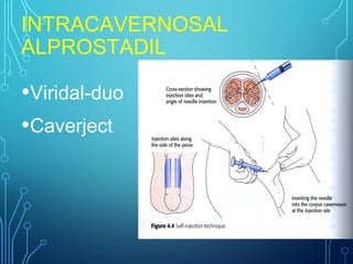 INTRACAVERNOSAL
ALPROSTADIL
•Viridal-duo
•Caverject
 