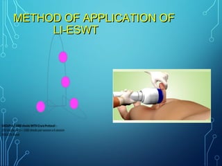 METHOD OF APPLICATION OFMETHOD OF APPLICATION OF
LI-ESWTLI-ESWT
 