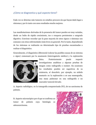 4
¿Cómo se diagnostica y qué aspecto tiene?
Cada vez se detectan más tumores en estadios precoces sin que hayan dado lugar a
síntomas y por lo tanto con unos resultados mucho mejores.
Las manifestaciones derivadas de la presencia del tumor pueden ser muy variadas,
desde un bulto de rápido crecimiento, tos o ronquera persistentes o sangrado
digestivo. Conviene recordar que la gran mayoría de estos signos o síntomas son
comunes con otras enfermedades (más leves en general). Por lo tanto, dependiendo
de los síntomas se realizarán un determinado tipo de pruebas encaminadas a
realizar el diagnóstico.
Generalmente, el diagnóstico diferencial (valorar las posibles causas de un síntoma
o signo) comenzará por la anamnesis (interrogatorio médico) y la exploración
física. Posteriormente puede requerir
investigaciones analíticas y algunas pruebas de
imagen como radiografía o escáner. En ocasiones
los resultados pueden ser sugestivos de su
existencia, al descubrir, por ejemplo, un nódulo
mamario en la exploración o en una mamografía,
una masa pulmonar en una radiografía o un
marcador tumoral elevado.
A. Aspecto radiológico, en la tomografía computerizada (TC), de un carcinoma de
pulmón.
B. Aspecto microscópico por el que se confirma un
tumor de pulmón cuya histología es
adenocarcinoma.
 