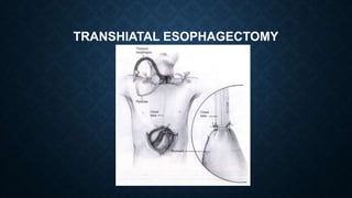 Esophageal cancer | PPTX