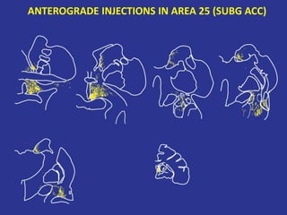 ANTEROGRADE INJECTIONS IN AREA 25 (SUBG ACC)
 