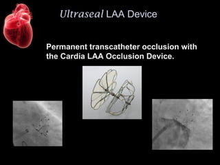 Ultraseal LAA Device
Permanent transcatheter occlusion with
the Cardia LAA Occlusion Device.
 