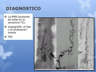 DIAGNOSTICO
 La RMN (aumento
de señal en la
secuencia T2).
 angiografía: el tipo
y la localización
exacta
 TAC
 