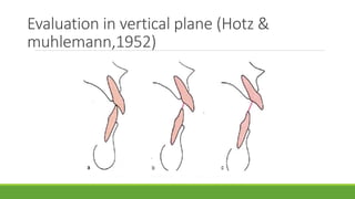 Evaluation in vertical plane (Hotz &
muhlemann,1952)
 
