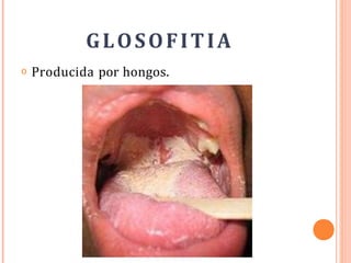 GLOSOFITIA
o Producida por hongos.
 