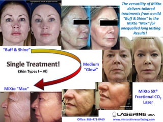 “Buff & Shine”
Medium
“Glow”
MiXto “Max”
MiXto SX®
Fractional CO2
Laser
www.mixtoskinresurfacing.comOffice: 866-471-0469
(Skin Types l – Vl)
The versatility of MiXto
delivers tailored
treatments from a mild
“Buff & Shine” to the
MiXto “Max” for
unequalled long lasting
Results!
3 months post-op
Courtesy of Dr. Alan Gardner 9 months post-op
 