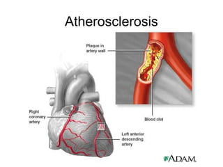 Atherosclerosis
 