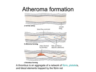 Atheroma formation
A thrombus is an aggregate of a network of fibrin, platelets,
and blood elements trapped by the fibrin net
 