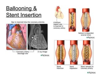 Ballooning &
Stent Insertion
 