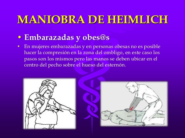 Maniobra de Heimlich