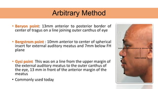 • Beryon point: 13mm anterior to posterior border of
center of tragus on a line joining outer canthus of eye
• Bergstrom point : 10mm anterior to center of spherical
insert for external auditory meatus and 7mm below FH
plane
• Gysi point: This was on a line from the upper margin of
the external auditory meatus to the outer canthus of
the eye, 13 mm in front of the anterior margin of the
meatus
• Commonly used today
Arbitrary Method
 