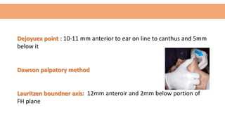 Dejoyuex point : 10-11 mm anterior to ear on line to canthus and 5mm
below it
Dawson palpatory method
Lauritzen boundner axis: 12mm anteroir and 2mm below portion of
FH plane
 
