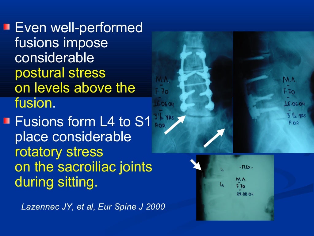 Dynamic Stabilization in the Surgical Management of Painful Lumbar Sp…