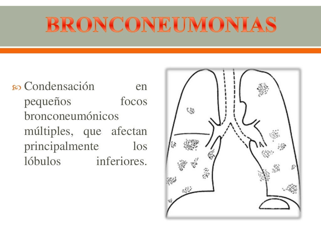 infección de vías respiratorias bajas infección de vías respiratorias bajas