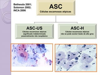 ASC
Células escamosas atípicas
ASC-US
Células escamosas atípicas
significado indeterminado
possivelmente não neoplásica
ASC-H
Células escamosas atípicas
não se pode excluir lesão de alto grau
Bethesda 2001;
Solomon 2002;
INCA 2006
 