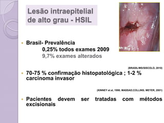 Lesão intraepitelial
de alto grau - HSIL
 Brasil- Prevalência
0,25% todos exames 2009
9,7% exames alterados
(BRASIL/MS/SISCOLO, 2010)
 70-75 % confirmação histopatológica ; 1-2 %
carcinoma invasor
(KINNEY et al, 1998; MASSAD;COLLINS; MEYER, 2001)
 Pacientes devem ser tratadas com métodos
excisionais
 
