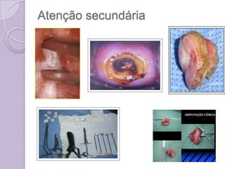 Atenção secundária
 