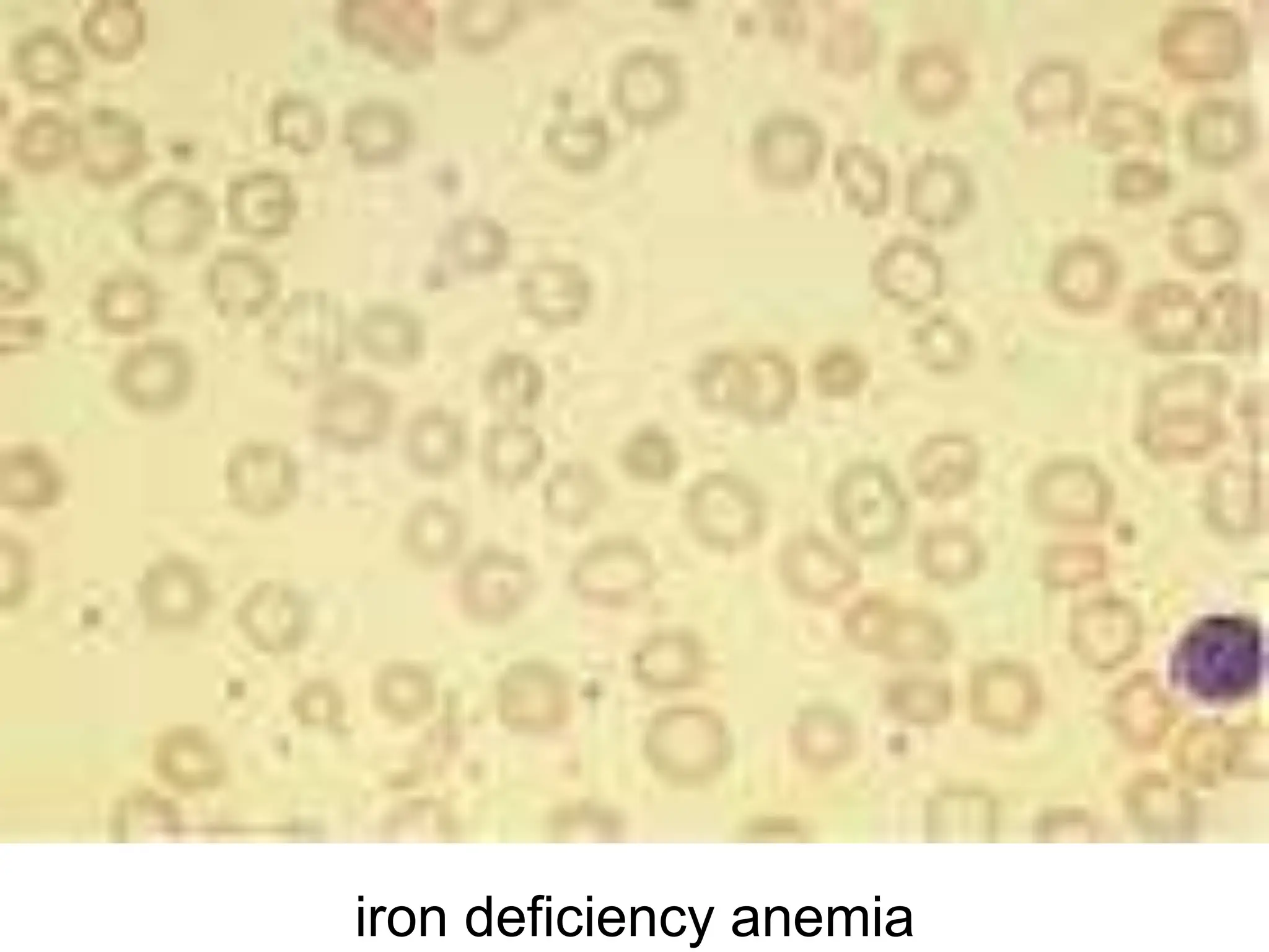Iron Deficient Rbcs 3 iron deficiency anemia blood diseases.ppt