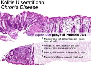 Kolitis Ulseratif dan
Chron’s Disease

Tujuan Diet penyakit inflamasi usus
1 Memperbaiki ketidakseimbangan cairan
dan elektrolit,

2 Mengganti kehilangan zat gizi dan
memperbaiki status gizi kurang,

3 Mencegah iritasi dan inflamasi lebih lanjut,
4 Mengistirahatkan usus pada masa akut

 