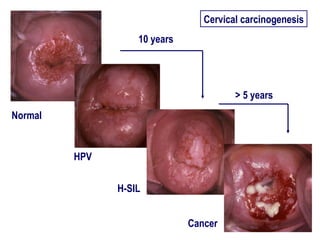 V. Kesic - Cervical cancer - State of the art