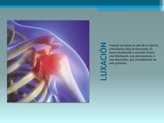 LUXACIÓN
Cuando un hueso se sale de su sitio la
articulación deja de funcionar. El
hueso desplazado a menudo forma
una hinchazón, una prominencia, o
una depresión, que normalmente no
esta presente.
 