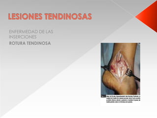 ENFERMEDAD DE LAS
INSERCIONES
ROTURA TENDINOSA
 