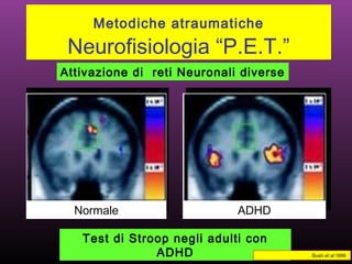 ADHDNormal
Metodiche atraumatiche
Neurofisiologia “P.E.T.”
Metodiche atraumatiche
Neurofisiologia “P.E.T.”
Test di Stroop negli adulti con
ADHD
ADHDNormale
Bush et al 1999
Attivazione di reti Neuronali diverse
 