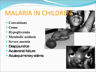 3 Malaria Clinical Features | PPT