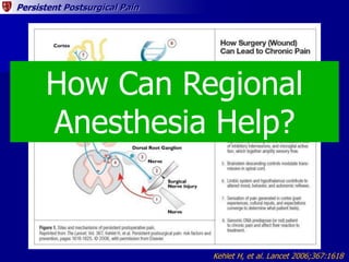 Persistent Postsurgical Pain
Kehlet H, et al. Lancet 2006;367:1618
How Can Regional
Anesthesia Help?
 