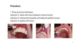 3 MAXILLARY NERVE BLOCKS seminar 3.pptx