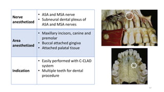 3 MAXILLARY NERVE BLOCKS seminar 3.pptx