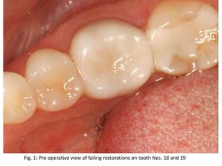 Fig. 1: Pre-operative view of failing restorations on tooth Nos. 18 and 19
 