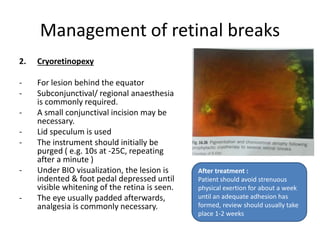 Management of retinal breaks
2. Cryoretinopexy
- For lesion behind the equator
- Subconjunctival/ regional anaesthesia
is commonly required.
- A small conjunctival incision may be
necessary.
- Lid speculum is used
- The instrument should initially be
purged ( e.g. 10s at -25C, repeating
after a minute )
- Under BIO visualization, the lesion is
indented & foot pedal depressed until
visible whitening of the retina is seen.
- The eye usually padded afterwards,
analgesia is commonly necessary.
After treatment :
Patient should avoid strenuous
physical exertion for about a week
until an adequate adhesion has
formed, review should usually take
place 1-2 weeks
 