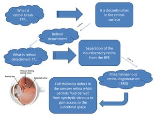 What is
retinal break
???..
Is a discontinuities
in the retinal
surface
What is retinal
detachment ??..
Separation of the
neuralsensory retina
from the RPE
Retinal
detachment
Rhegmatogenous
retinal degeneration
( RRD)
Full thickness defect in
the sensory retina which
permits fluid derived
from synchytic vitreous to
gain access to the
subretinal space
 