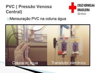 �Mensuração PVC na coluna água
PVC ( Pressão Venosa
Central)
 