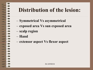 Distribution of the lesion:
– Symmetrical Vs asymmetrical
– exposed area Vs sun exposed area
– scalp region
– Hand
– extensor aspect Vs flexor aspect
Dr ANNIS B
 