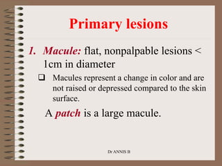 Primary lesions
1. Macule: flat, nonpalpable lesions <
1cm in diameter
 Macules represent a change in color and are
not raised or depressed compared to the skin
surface.
A patch is a large macule.
Dr ANNIS B
 