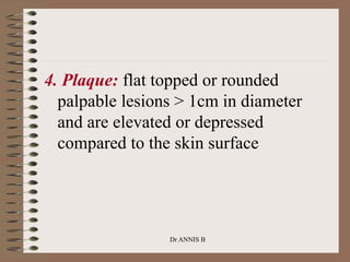4. Plaque: flat topped or rounded
palpable lesions > 1cm in diameter
and are elevated or depressed
compared to the skin surface
Dr ANNIS B
 