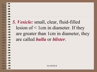 5. Vesicle: small, clear, fluid-filled
lesion of < 1cm in diameter. If they
are greater than 1cm in diameter, they
are called bulla or blister.
Dr ANNIS B
 