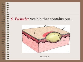 6. Pustule: vesicle that contains pus.
Dr ANNIS B
 