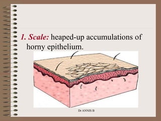 1. Scale: heaped-up accumulations of
horny epithelium.
Dr ANNIS B
 