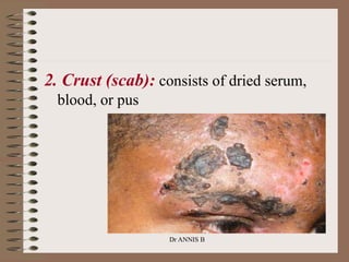 2. Crust (scab): consists of dried serum,
blood, or pus
Dr ANNIS B
 