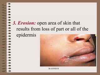 3. Erosion: open area of skin that
results from loss of part or all of the
epidermis
Dr ANNIS B
 