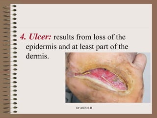 4. Ulcer: results from loss of the
epidermis and at least part of the
dermis.
Dr ANNIS B
 
