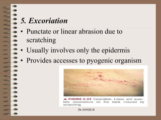 Dr ANNIS B
5. Excoriation
• Punctate or linear abrasion due to
scratching
• Usually involves only the epidermis
• Provides accesses to pyogenic organism
 